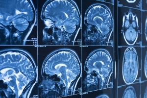 A series of brain scans